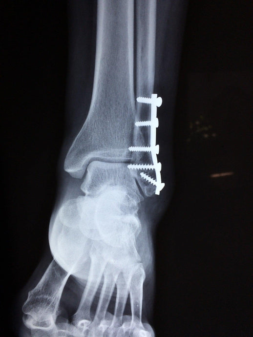 Ankle Fractures- Symptoms, Treatments and Recovery with the KneeRover